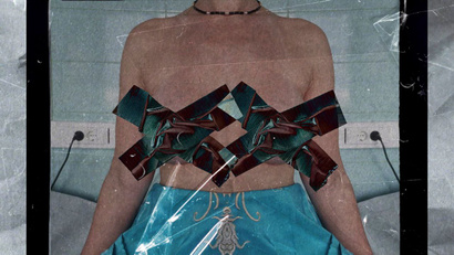 Капсулярная контрактура